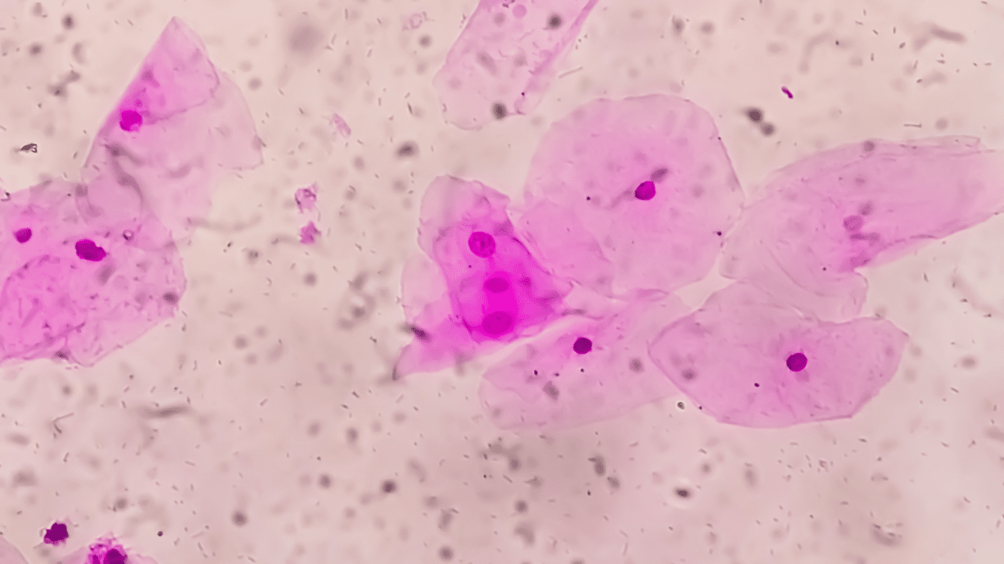 Microscopic photo of cells containing bacterial vaginosis